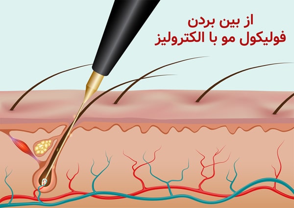 مکانیسم الکترولیز