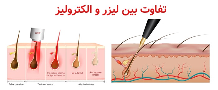 تفاوت لیزر و الکترولیز